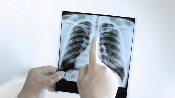 Tuberculosis On A Human Lung X Ray. The Doctor Analyzes The X Ray Of The Lungs On A White Background
