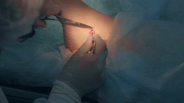 Surgeon Making Surgery of Removal Ankle Hygroma Using Medical Tools in Hospital