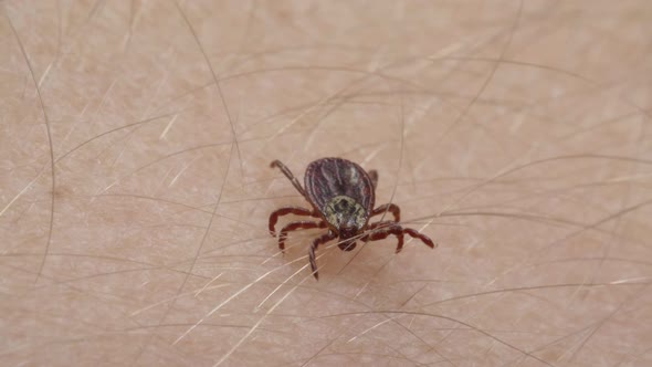 Blood-sucking Mite Tick Creepes on the Human Skin Through the Hair alt