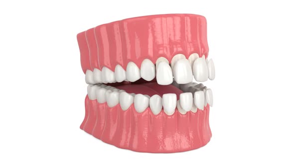 Jaw with installing dental veneers over white background