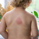 Mosquito bites on a child back. Selective focus. - PhotoDune Item for Sale