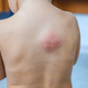 Mosquito bites on a child back. Selective focus. - PhotoDune Item for Sale