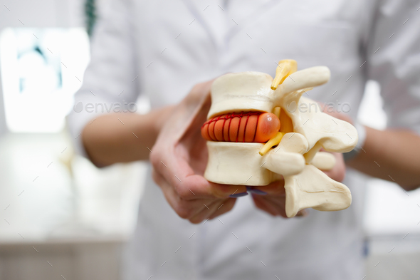 The doctor holds in his hands a model of a herniated lumbar disc of the spine