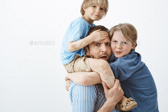 Indoor shot of concerned tired father holding cute blond son with vitiligo on shoulders, frowning an