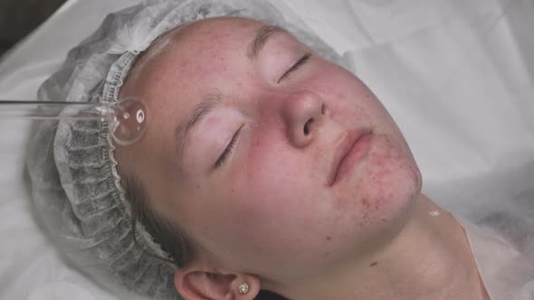 Darsonvalization of the Face in a Young Girl with Problem Skin alt