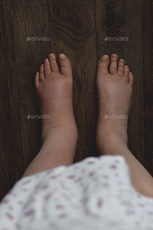 Female legs and feet with lymphedema condition Stock Photo by JulieAlexK