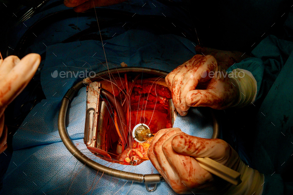Due to a malfunction of the heart valve, the doctor performs an open heart surgery to replace the - Stock Photo - Images