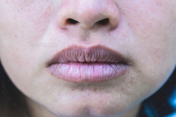 Close up asian woman mouth and face with brittle and dry lips. Lip salve and wounds