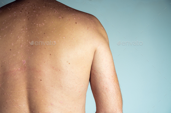 Close-up of red inflamed flaky itchy skin of bare back with blemishes of unrecognizable man sufferin