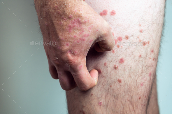 Unrecognizable man suffering from psoriasis, scratching thick scaly ...