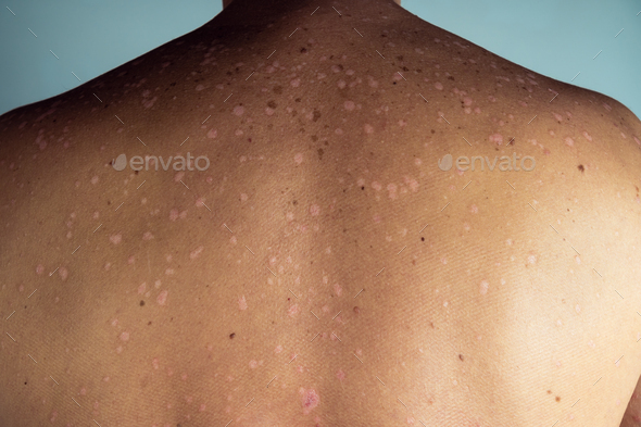 Close-up of red inflamed skin of back with blemishes of unrecognizable man suffering from psoriasis