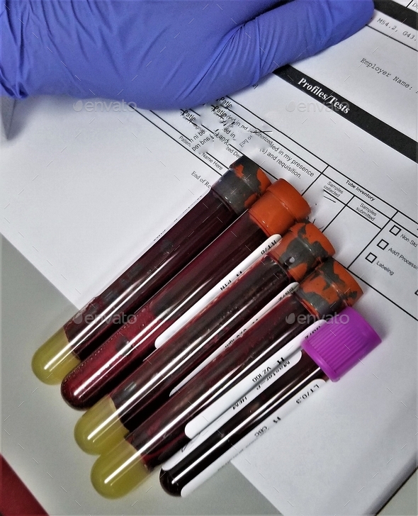 Blood! Vials of Blood for Laboratory Testing! Stock Photo by AZBLT