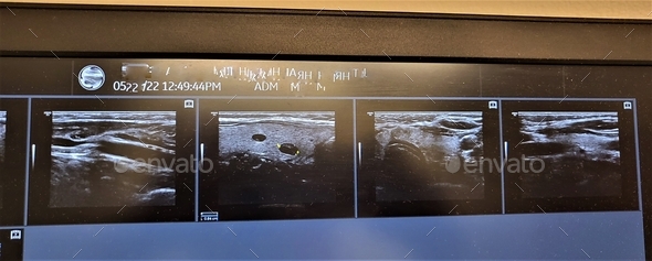 Healthcare and Medicine! Ultrasound Images of Patient with Nodules on the Thyroid Gland.