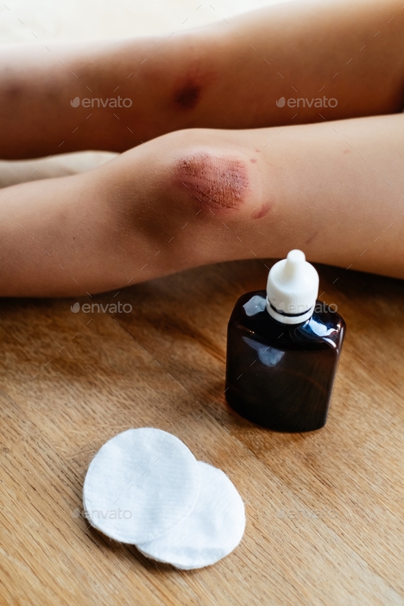 Deep scratches on the skin on the kids knee Stock Photo by ninelutsk