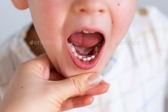 Children shark teeth, first tooth that appears in childhood behind baby