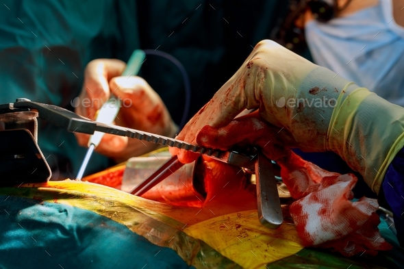 Liver transplant in operating room, Surgery in hospital on the open heart chest during heart surgery