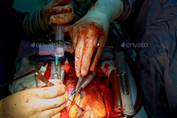 Surgeon during an operation on the open heart chest during heart surgery