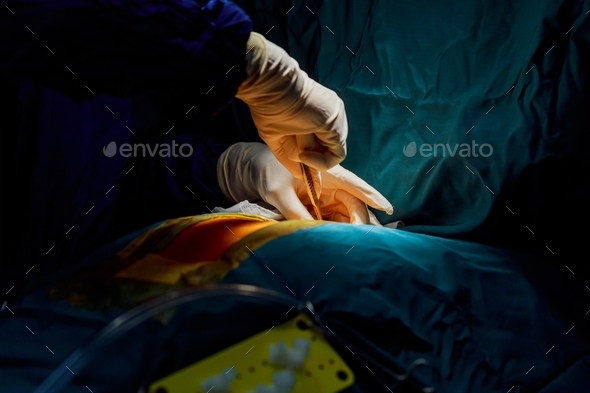 Cutting the chest during an operation on the heart Surgical breast opening during surgical operation