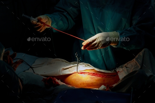 A surgeon performs vein separation for Coronary Artery Bypass Grafting operation in the operating