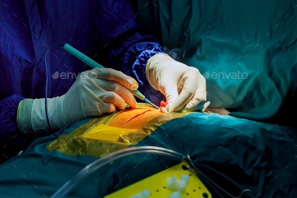 Surgeon during an operation on the open heart Cutting the chest during an operation on the heart