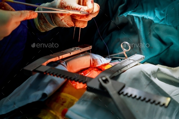 Invasive surgical approach with a small incision for heart valve surgery for removing transcatheter