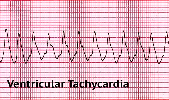 ECG - Electrocardiograph - Ventricular Tachycardia