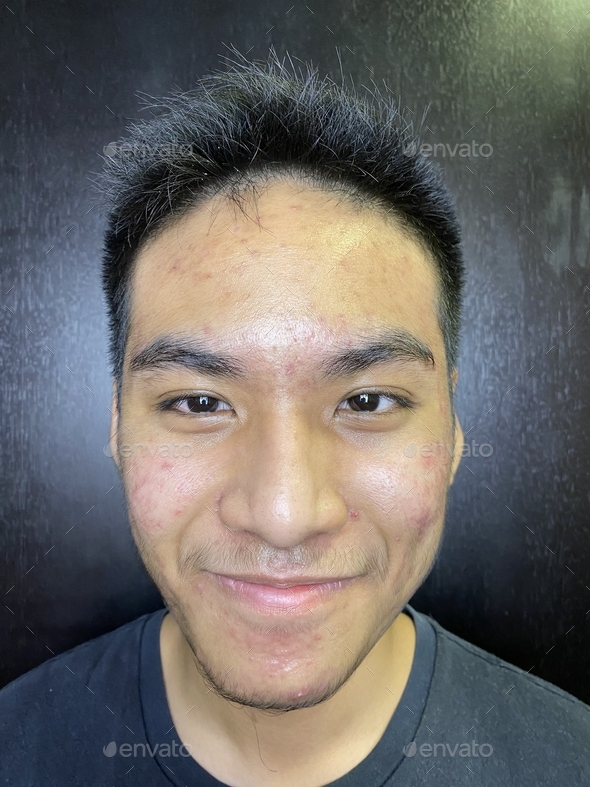 Portrait of an Asian teenager with serious acne problems and deep ...