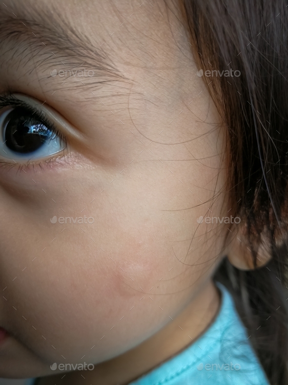 Little girl has allergies with mosquitoes bite and itching her skin