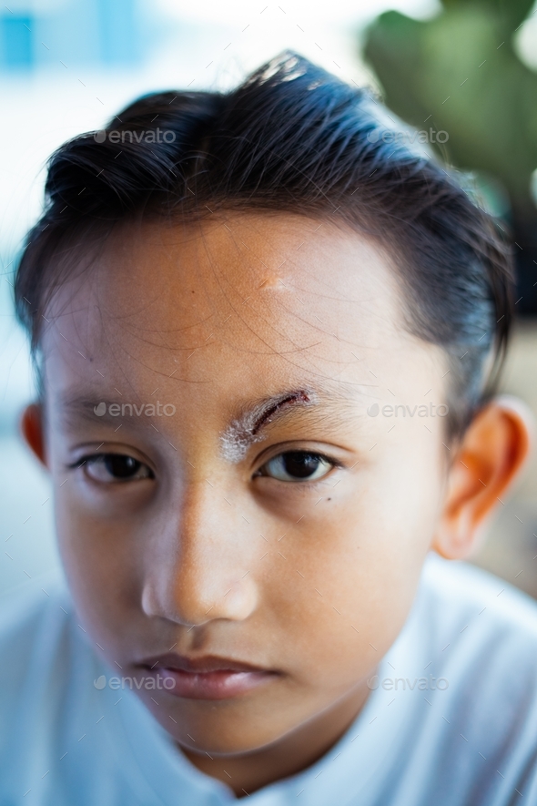 Healed minor cut wound after the surgical glue stitches. Scar at left eyebrow of Southeast Asian,