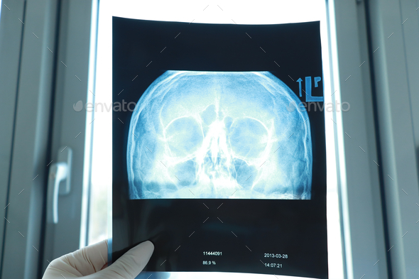 X-ray of the head and eye socket