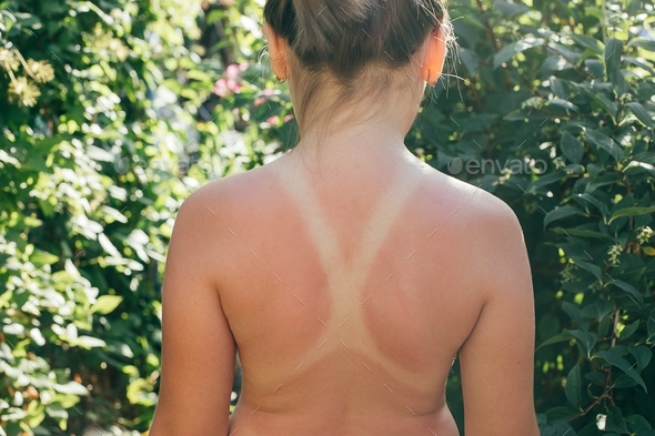 Sad smile painted on the man back with sunscreen. Sunburn