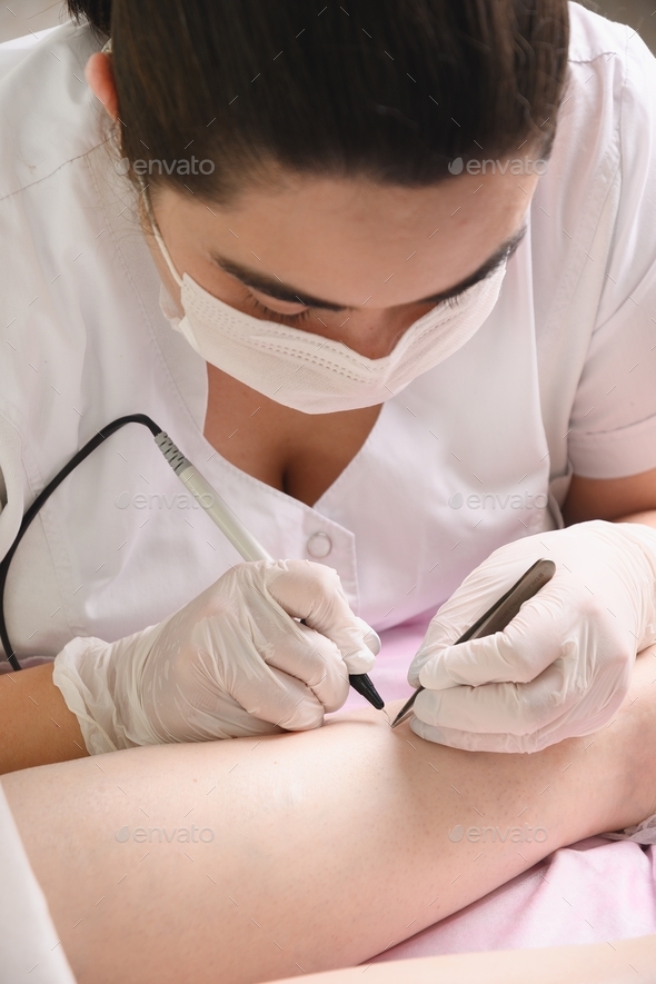 Removal of hair permanently in a woman's legs using electrolysis. Stock Photo by Svetlana_Lazhko