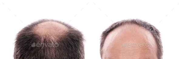 man with circular hair loss at the back of the head and receding hairline at the front