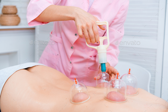 Multiple vacuum cup of medical cupping therapy on woman body. Bank treatment