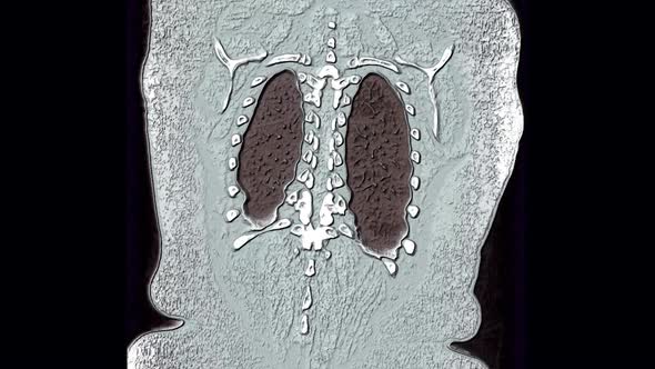 3D Monochrome MRI Scan of The Lungs and Bronchi alt