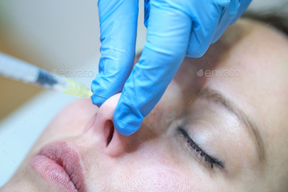 elevation of the nasal tip injecting botulinum toxin