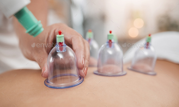 Glass, vacuum cups and cupping therapy for a massage or physical therapy treatment with heating. He