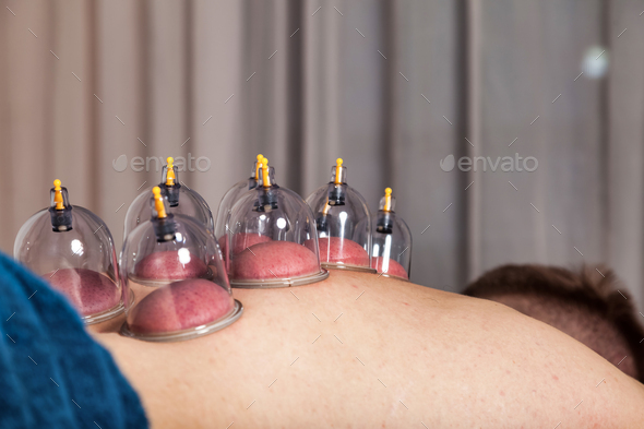 Man patient with therapy vacuo cups, alternative medicine. Multiple vacuum cups on human back