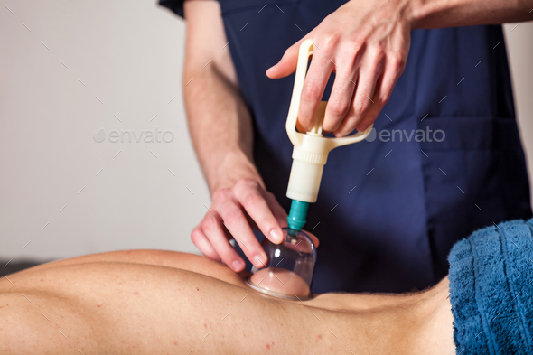 Doctor doing vacuum cups for patient, therapy. Medical cupping therapy on human body, close-up