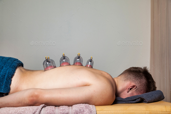 Multiple vacuum cups on human back, medical cupping therapy in room