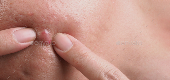 Big Acne Cyst Abscess or Ulcer Swollen area within face skin tissue. - Stock Photo - Images