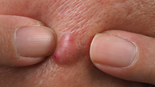Big Acne Cyst Abscess or Ulcer Swollen area within face skin tissue. - Stock Photo - Images
