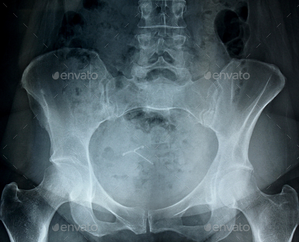 X Ray Of A Female Pelvis, Hip Bones And IUD Stock Photo By Iheartcreative