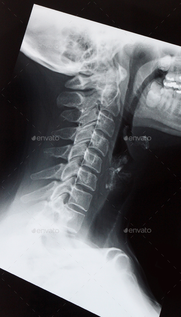 Medical X ray of a female neck, jaw and spine Stock Photo by iheartcreative