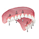 Maxillary prosthesis with gum placed on 6 implants