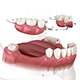 Removable partial denture, mandibular prosthesis