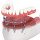 Mandibular prosthesis with gum All on 4 system supported by implants