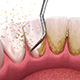 Oral hygiene: Scaling and root planing (conventional periodontal therapy).