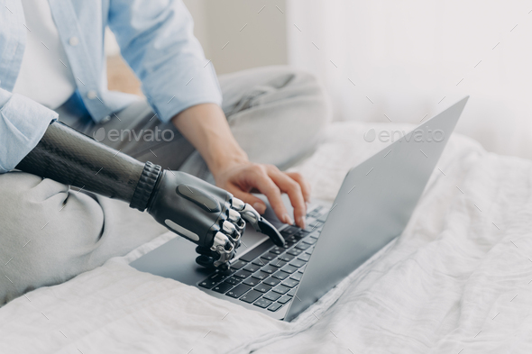 Bionic prosthesis and healthy arm. Hands of disabled girl are typing on keyboard of laptop.