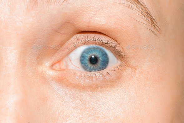 Close-up of human blue eye with bloody vein looking at camera. Macro photo of eye vessel disease